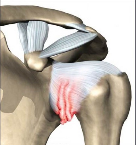 capsulite adesiva spalla congelata frozen shoulder primaria secondaria