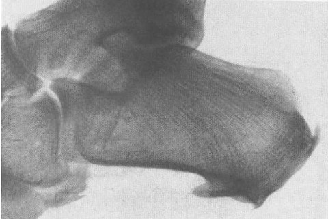 spina sperone calcaneare trattamento bioforesi