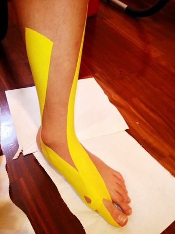 taping neuromuscolare sostegno articolare muscolare alluce valgo